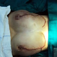 海南16歲＂巨乳癥＂少女手術(shù)治療成功 10天后拆線