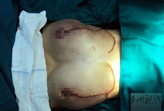 海南16歲"巨乳癥"