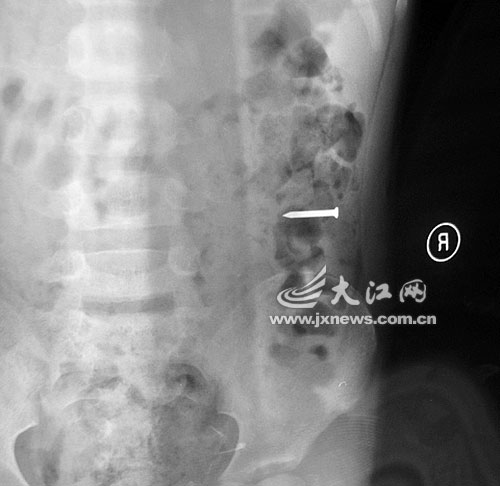 留守兒童吞硬幣留父母