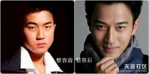 整容部位二:眼角