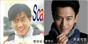 整容部位四:鼻子