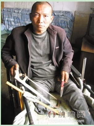 男子鋼鋸截肢右腿 患上怪病腿部潰爛自己自己動手截肢