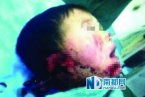 男童遭嬸嬸割雙耳 湖北老河口市薛集鎮王河村張啟慧