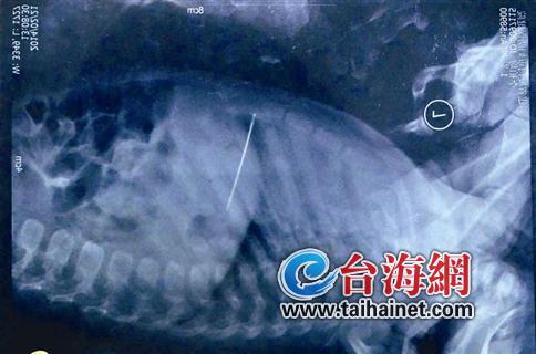 5厘米長的繡花針扎入體內 1歲嬰兒被針扎入胸腔