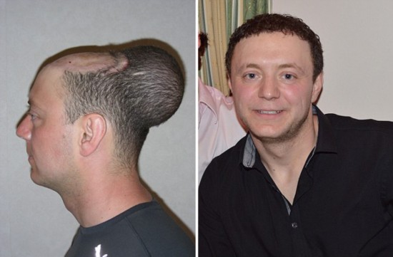 英國男子頭皮植入氣球來生發(fā)