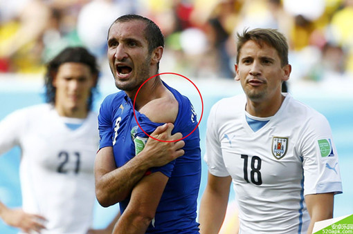 蘇亞雷斯咬人圖片