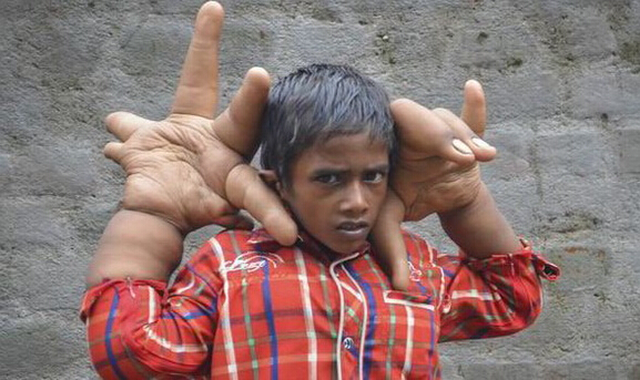 八歲男童長(zhǎng)巨手