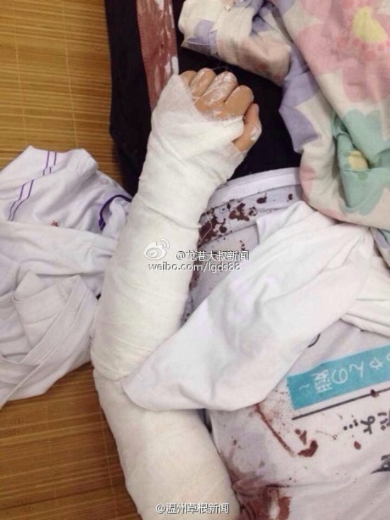 蒼南龍港第九中學女生用剪刀捅傷同學