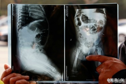 聊城11月女嬰被扎12根針