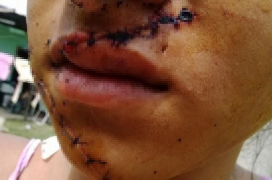 少女因太美遭毀容