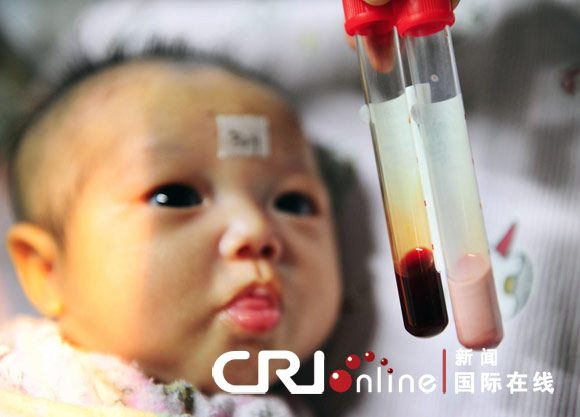 嬰兒血液乳白色