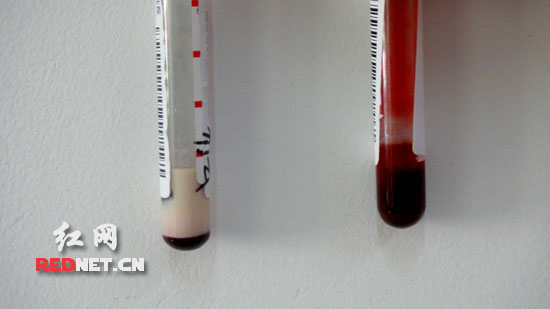 嬰兒血液乳白色