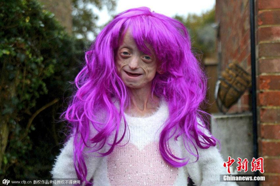 女童患早衰11歲似80歲老太