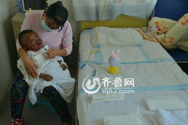 中毒性表皮壞死松解癥男童