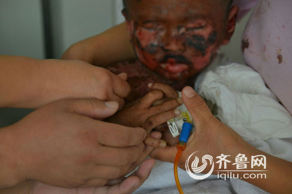 中毒性表皮壞死松解癥男童