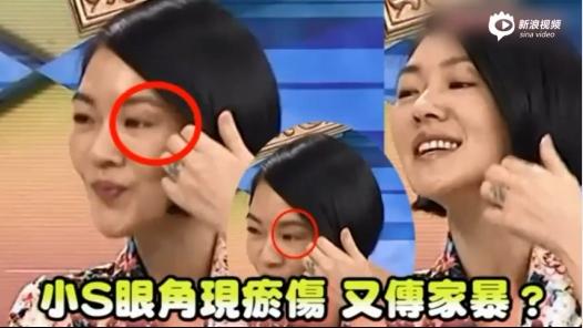 小s疑遭到家暴眼角有傷