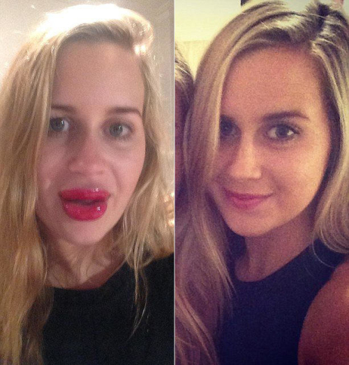 用豐唇器成香腸嘴