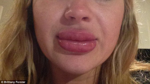 用豐唇器成香腸嘴