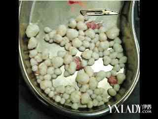 男子肩膀長珍珠竟然是腫瘤