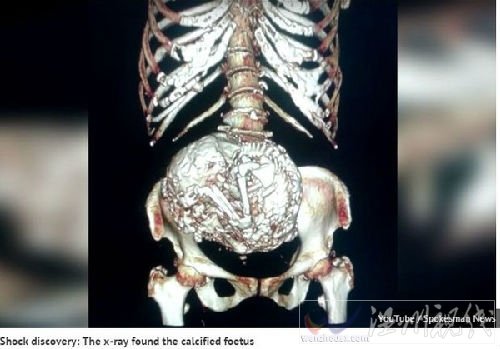 老婦人子宮內藏60年鈣化胎兒