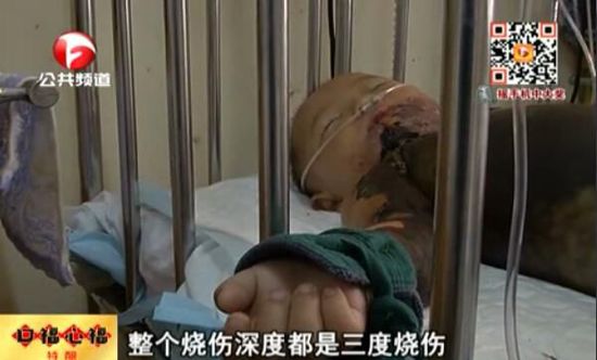 男童跌入開水盆燙傷