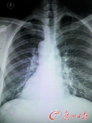 X光片上袁先生的心臟陰影在右邊。