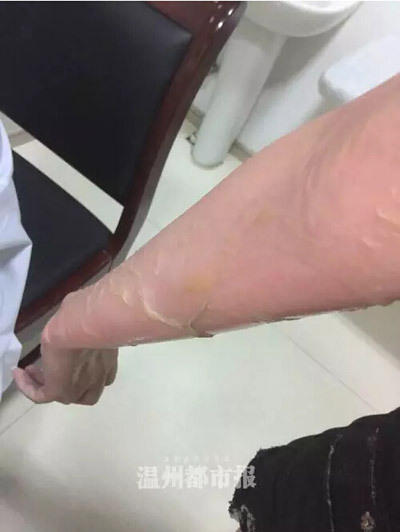 女子遭服務員潑熱湯