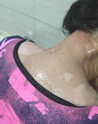 女子遭服務員潑熱湯