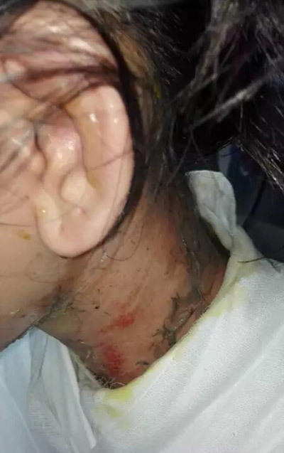 女子遭服務員潑熱湯