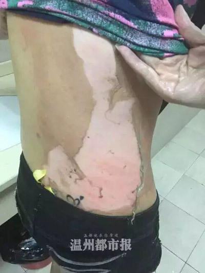 女子遭服務員潑熱湯