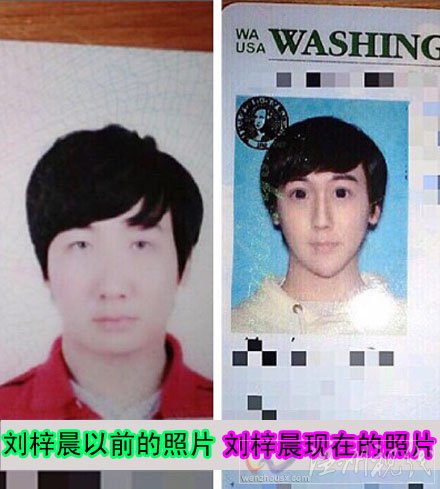 劉梓晨整容前照片