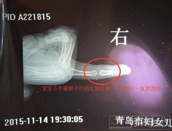 李滄區(qū)大蘋果幼兒園老師毆打幼童