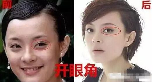 孫儷自曝整過容