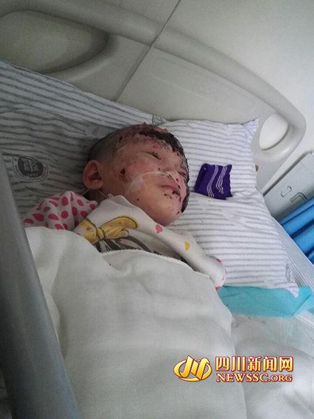 女孩烤火栽進煤爐