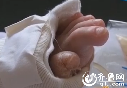 男童連續高燒8年