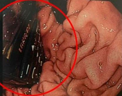 男子手機(jī)吞入食道