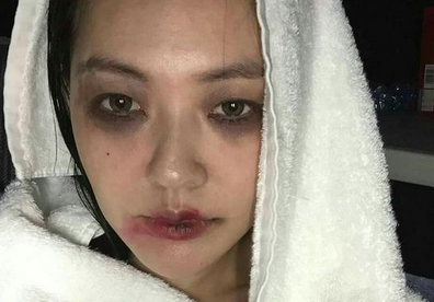 小s滿臉淤青出鏡