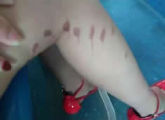 短裙女孩遭潑液體灼傷 福州警方介入調查