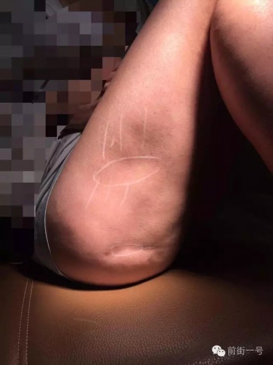 女子大腿凹凸不平