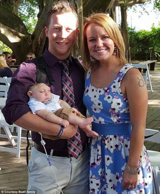 無腦畸形男嬰存活