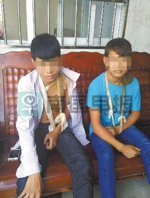 少年遭敲斷鎖骨