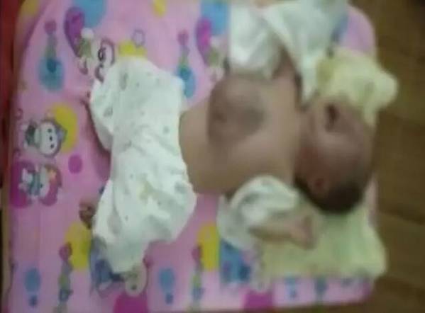 寶寶心臟長外面