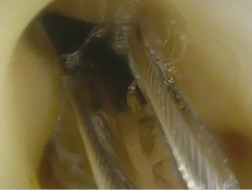 女孩吞下大塊玻璃