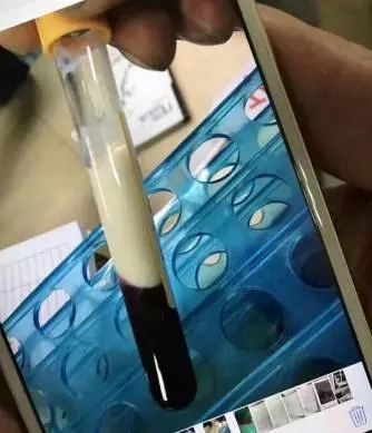 抽出的血馬上凝固 16歲少年糖尿病