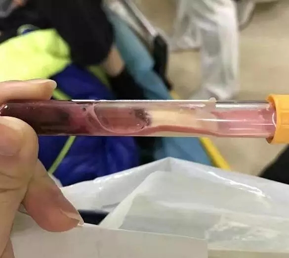 抽出的血馬上凝固 16歲少年糖尿病