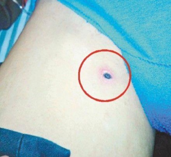 紹興男子被恙蟲咬后發(fā)高燒