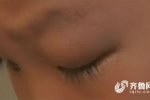 男童眼中發現電池 怎么進入眼睛不知道
