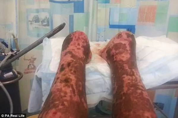 被愛犬舔舐后截肢