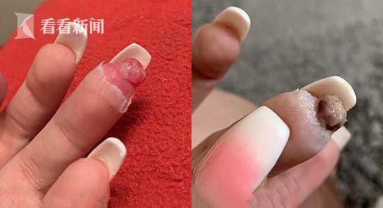 孕婦做美甲遭感染