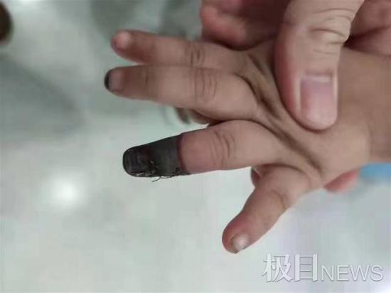 家人錯誤包扎致3歲女童手指壞死